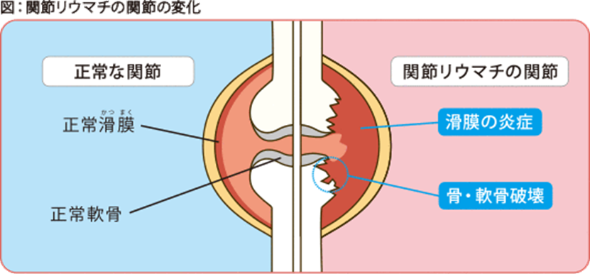 関節リウマチの関節の変化